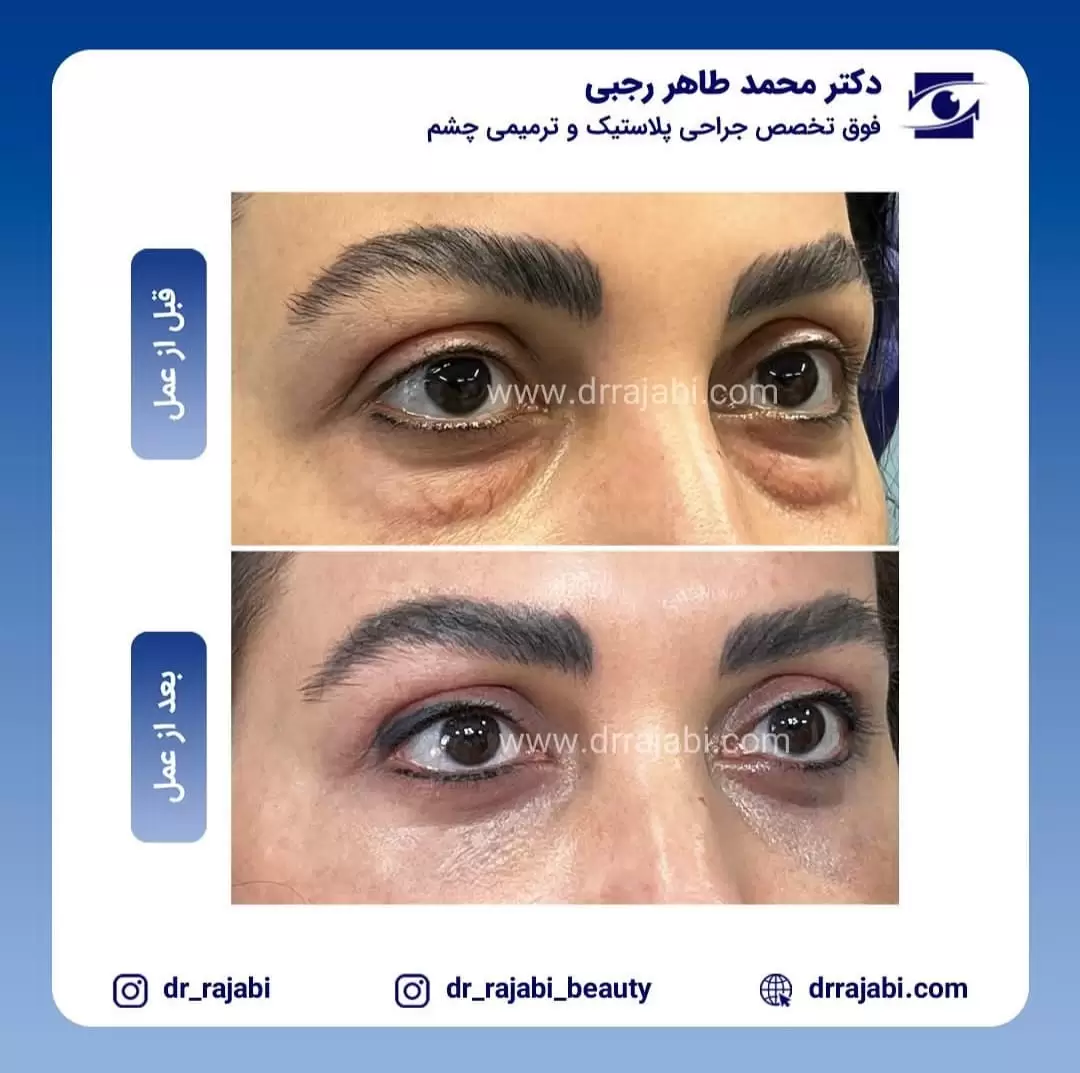 جراحی بلفاروپلاستی پلک پایین بدون بخیه
